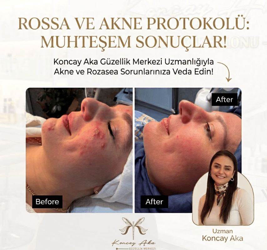 Rosacea & Akne Protokolü